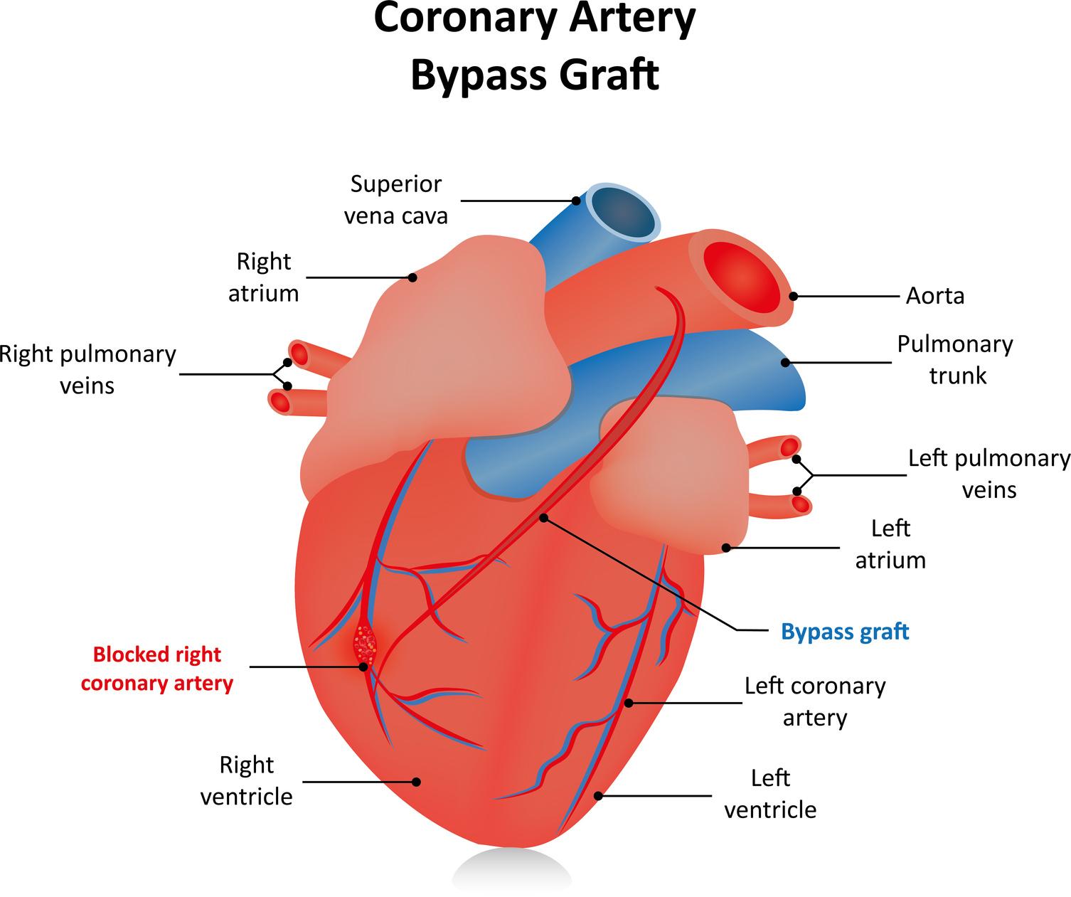 Coronary Artery Bypass (Conventional)
