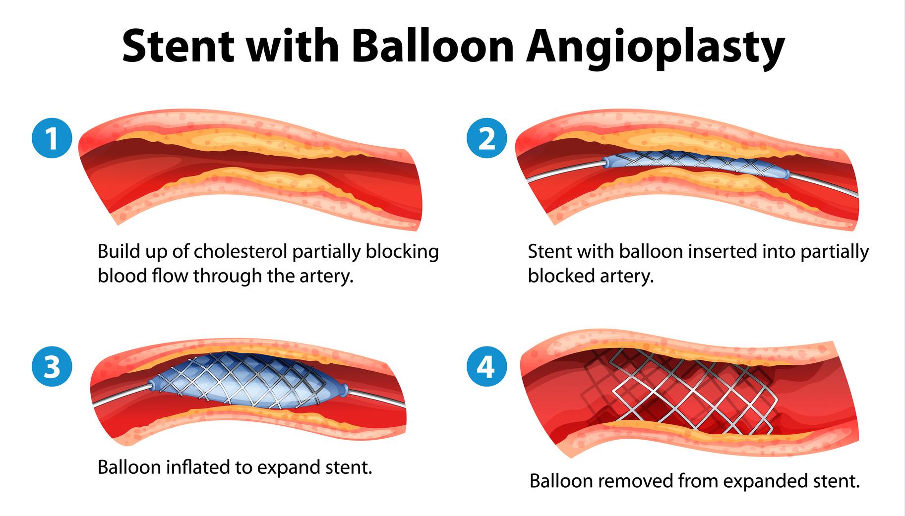 Angioplastie par Ballonnet et Placement de Stent